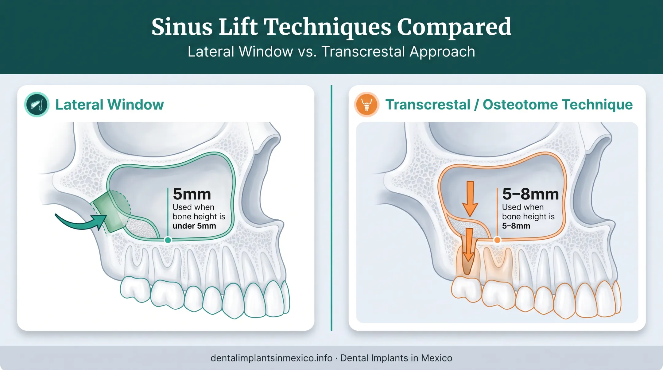 Lateral window versus transcrestal sinus lift technique comparison diagram