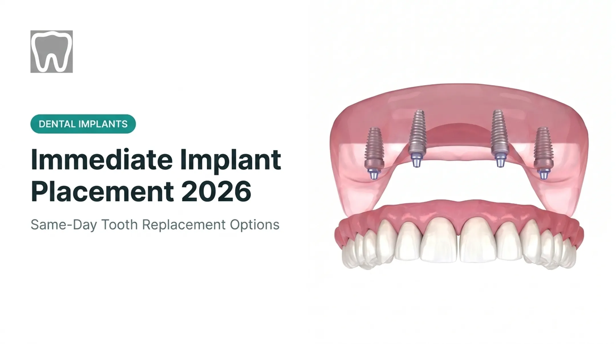 Immediate Implant Placement 2026