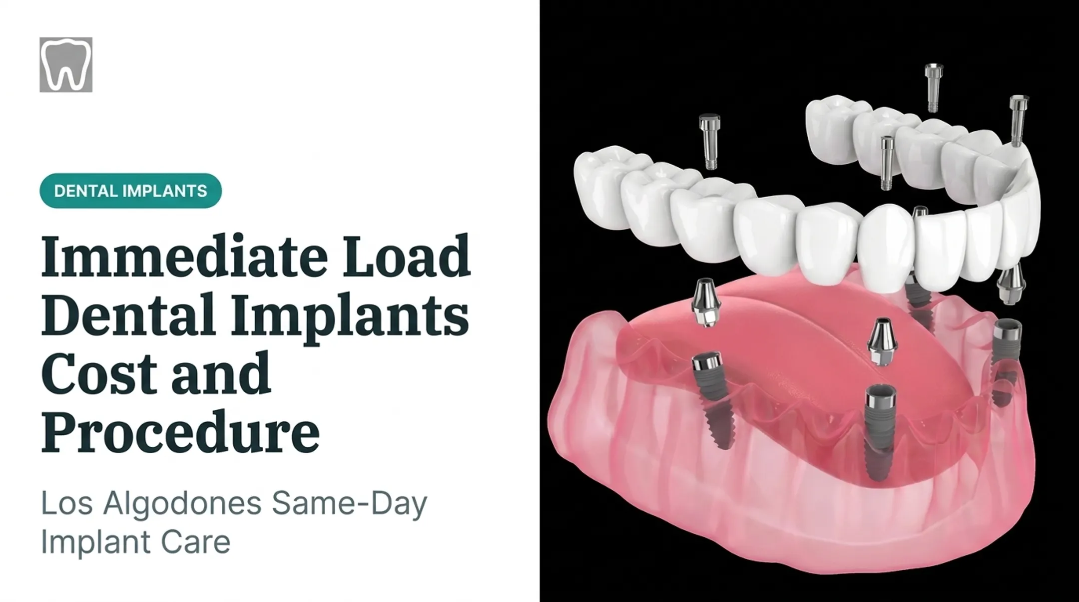 Immediate Load Dental Implants Cost and Procedure