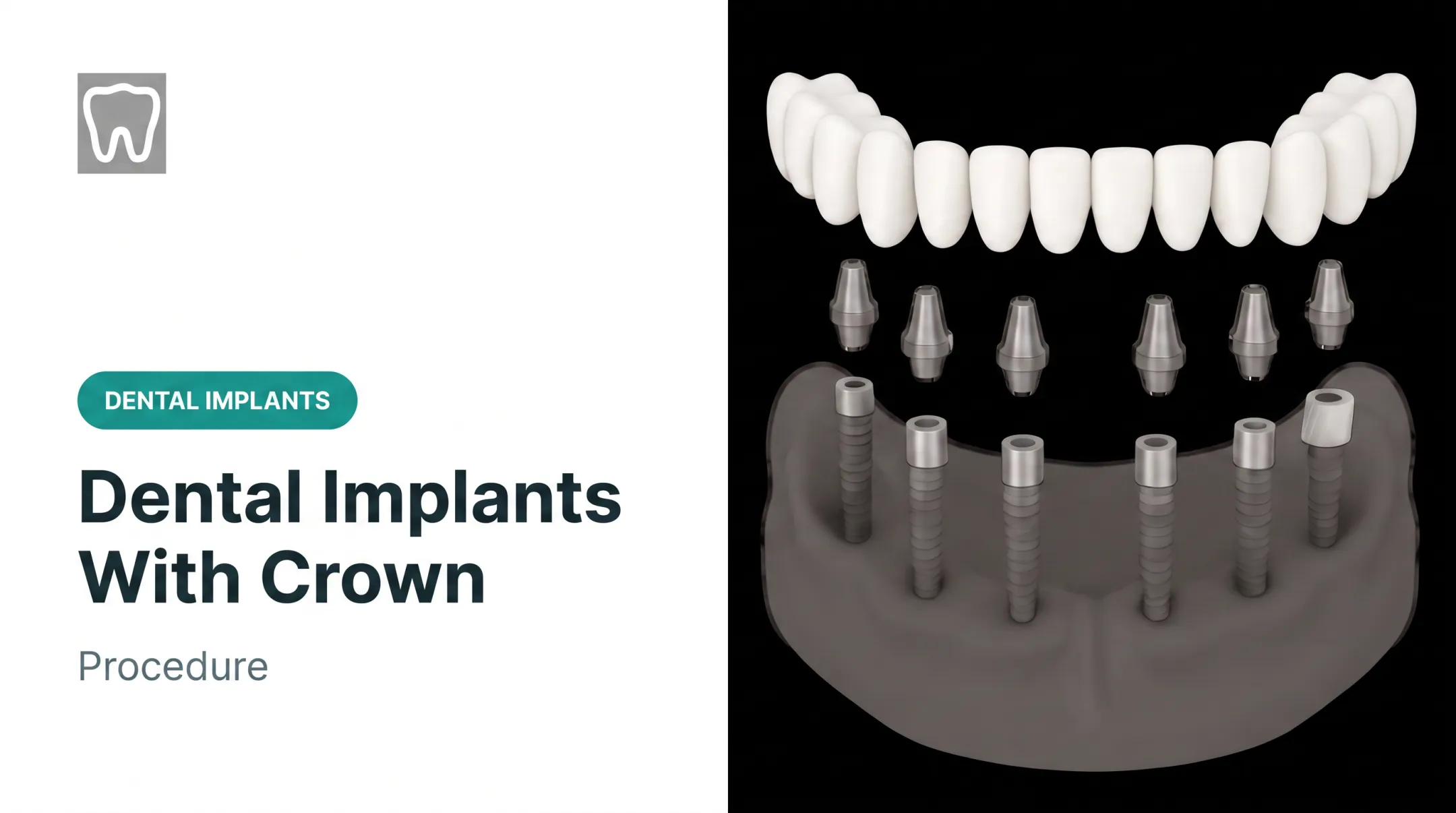 Dental Implants With Crown: Procedure