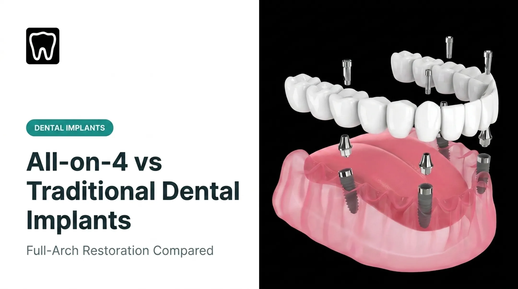 All-on-4 vs Traditional Dental Implants