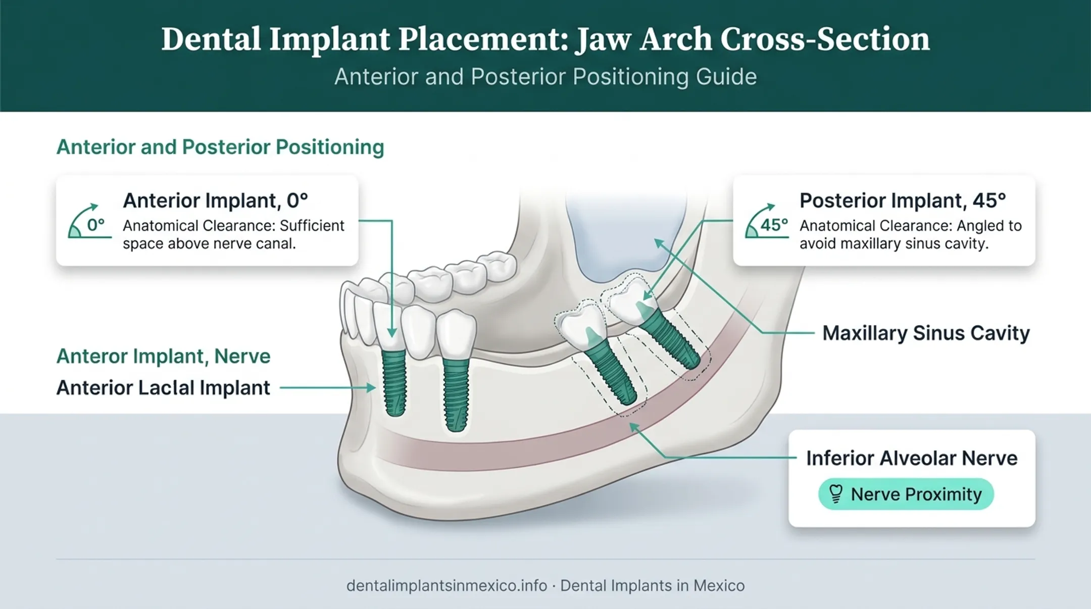 All-on-4 angled implant placement diagram showing anterior and posterior positioning
