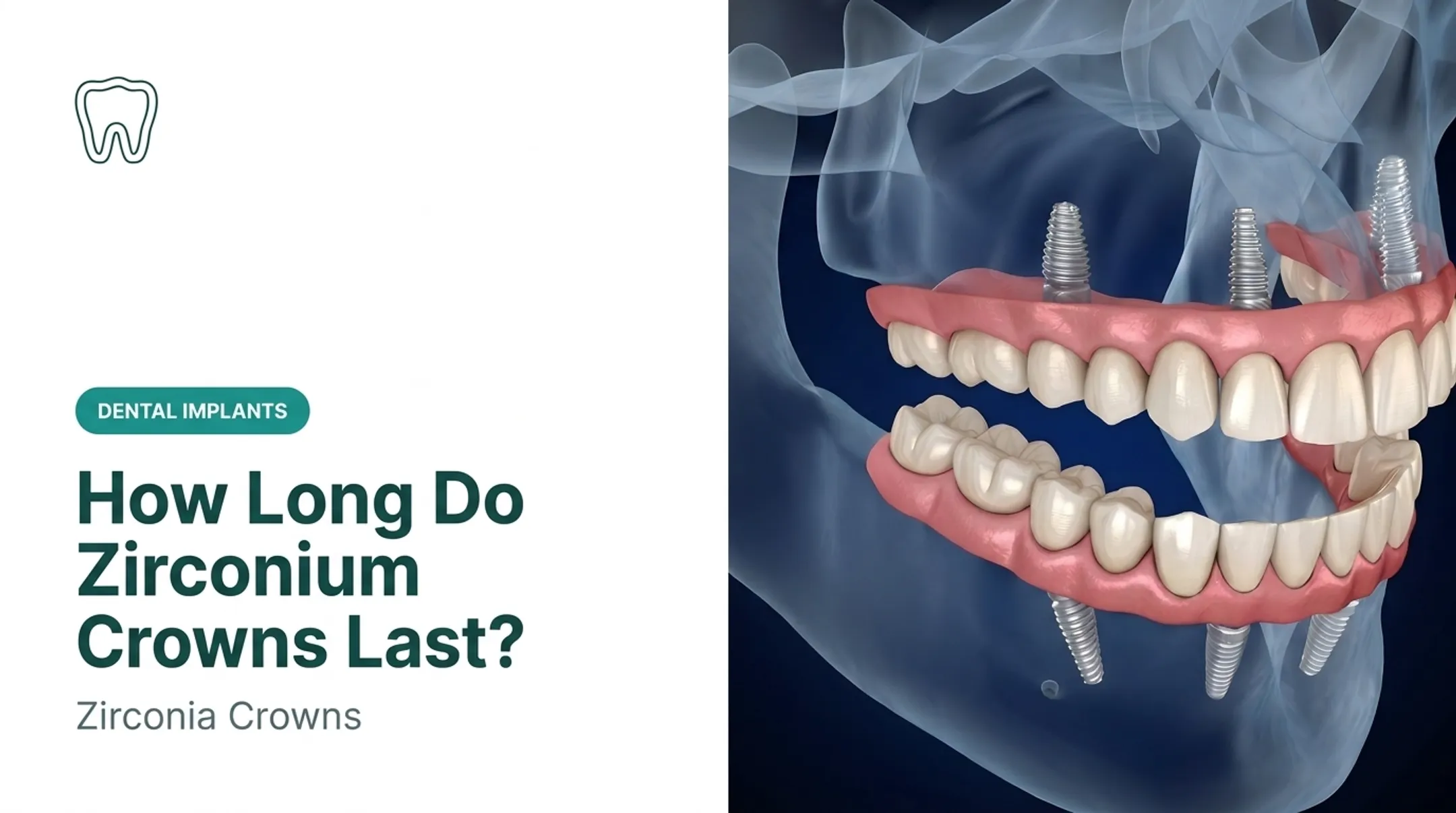 How Long Do Zirconium Crowns Last? Zirconia Crowns