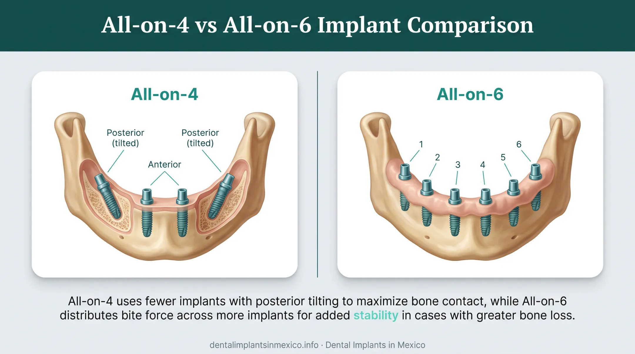 All-on-4 versus All-on-6 implant placement comparison diagram