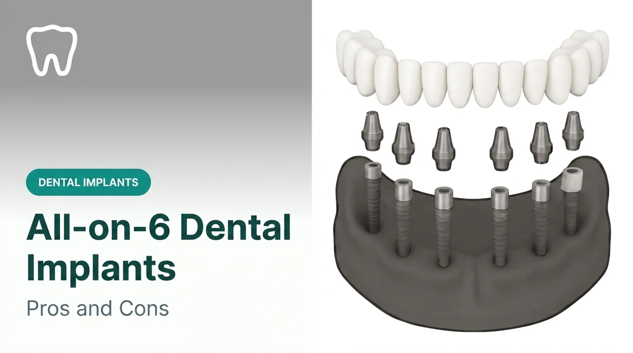 All-on-6 Dental Implants: Pros and Cons