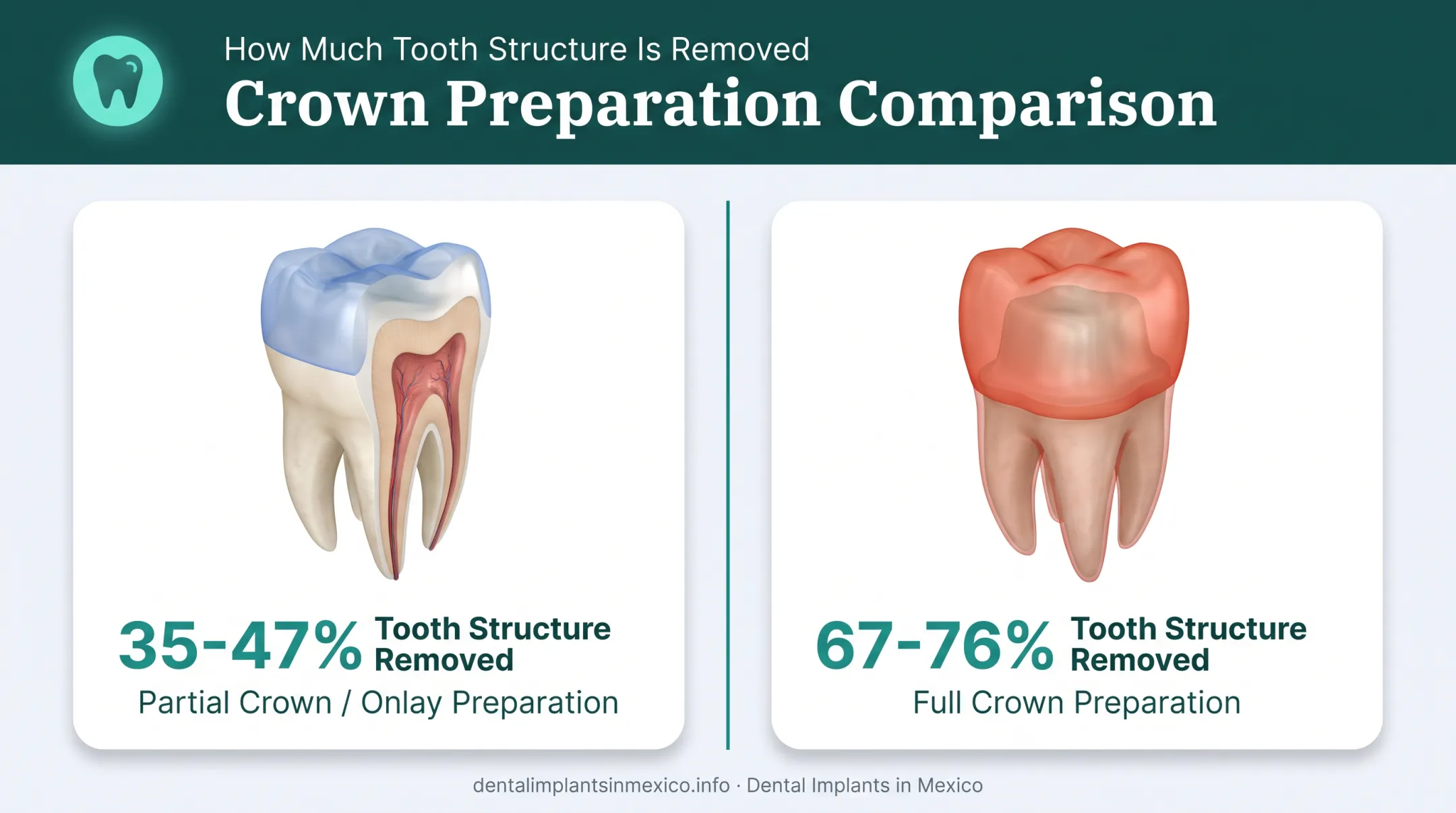 Partial crown versus full crown tooth structure removal comparison