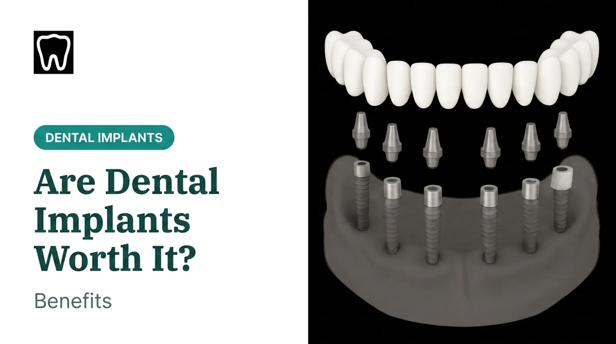 Are Dental Implants Worth It? Benefits