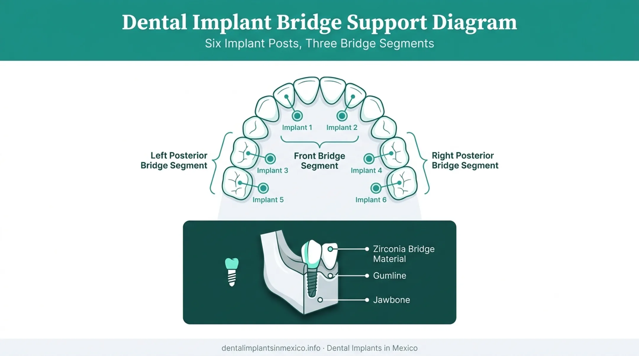 3 on 6 dental implants arch diagram showing six implant positions