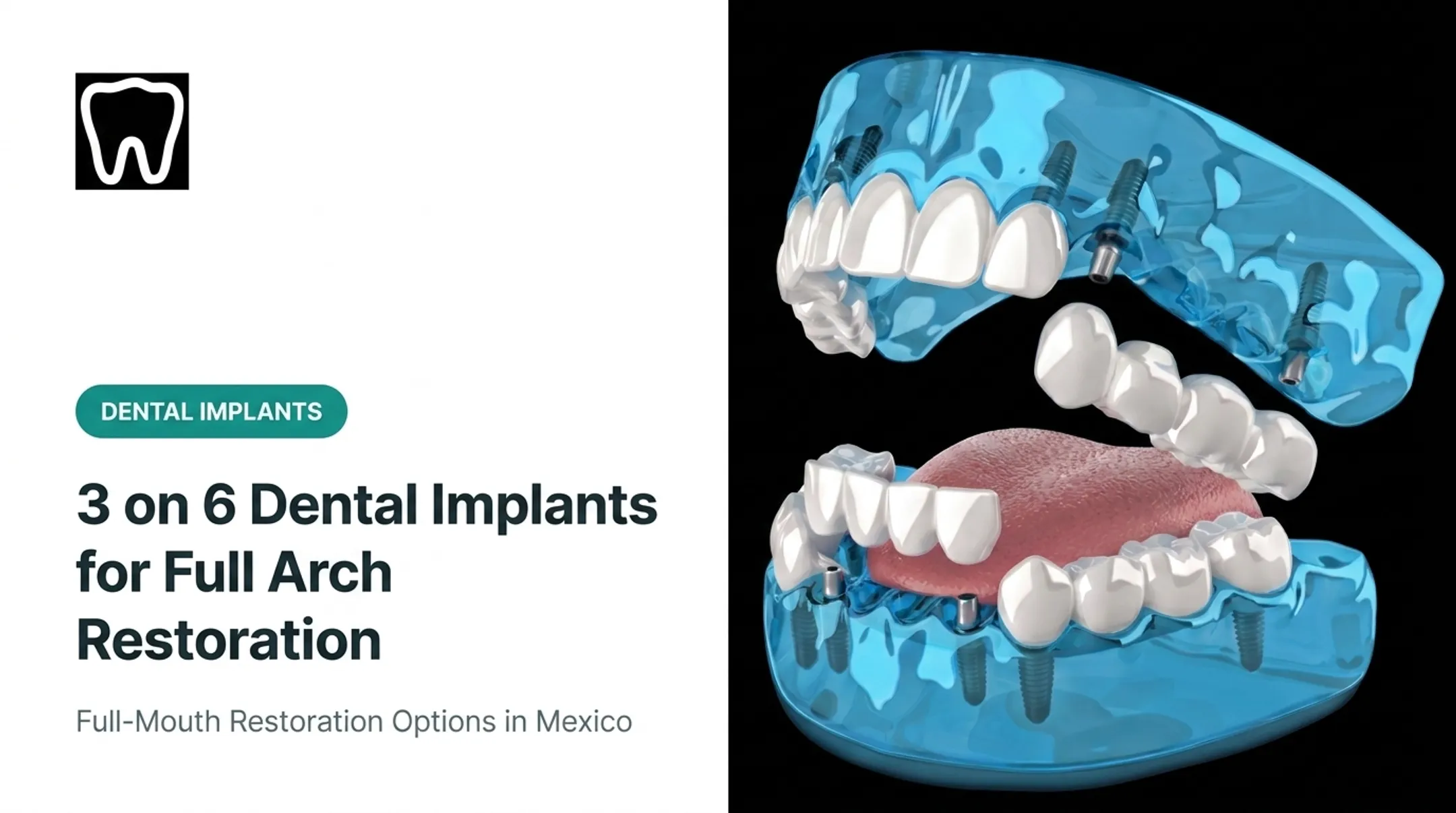 3 on 6 Dental Implants for Full Arch Restoration