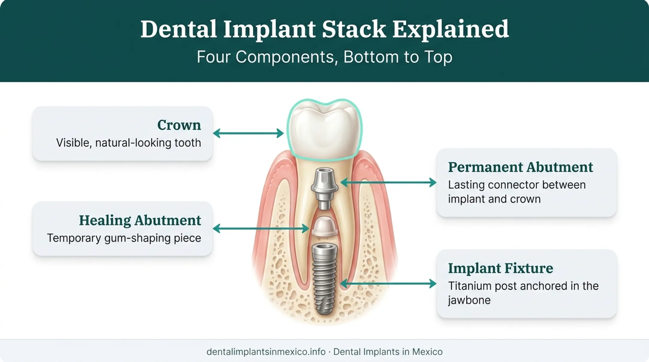 Dental implant structure showing fixture healing abutment permanent abutment and crown