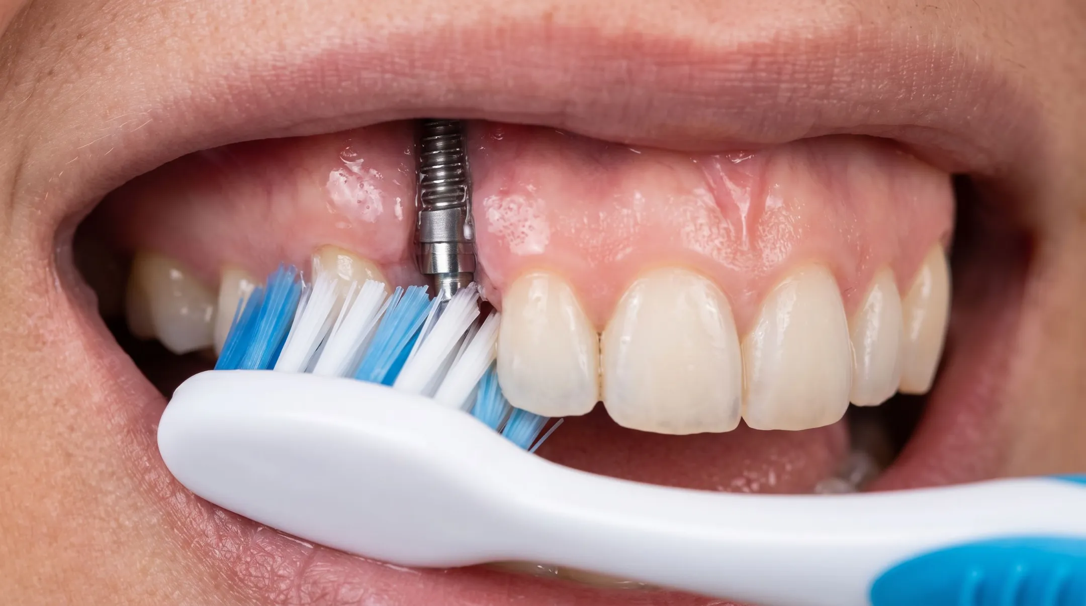 Dental patient practicing gentle oral hygiene around implant site