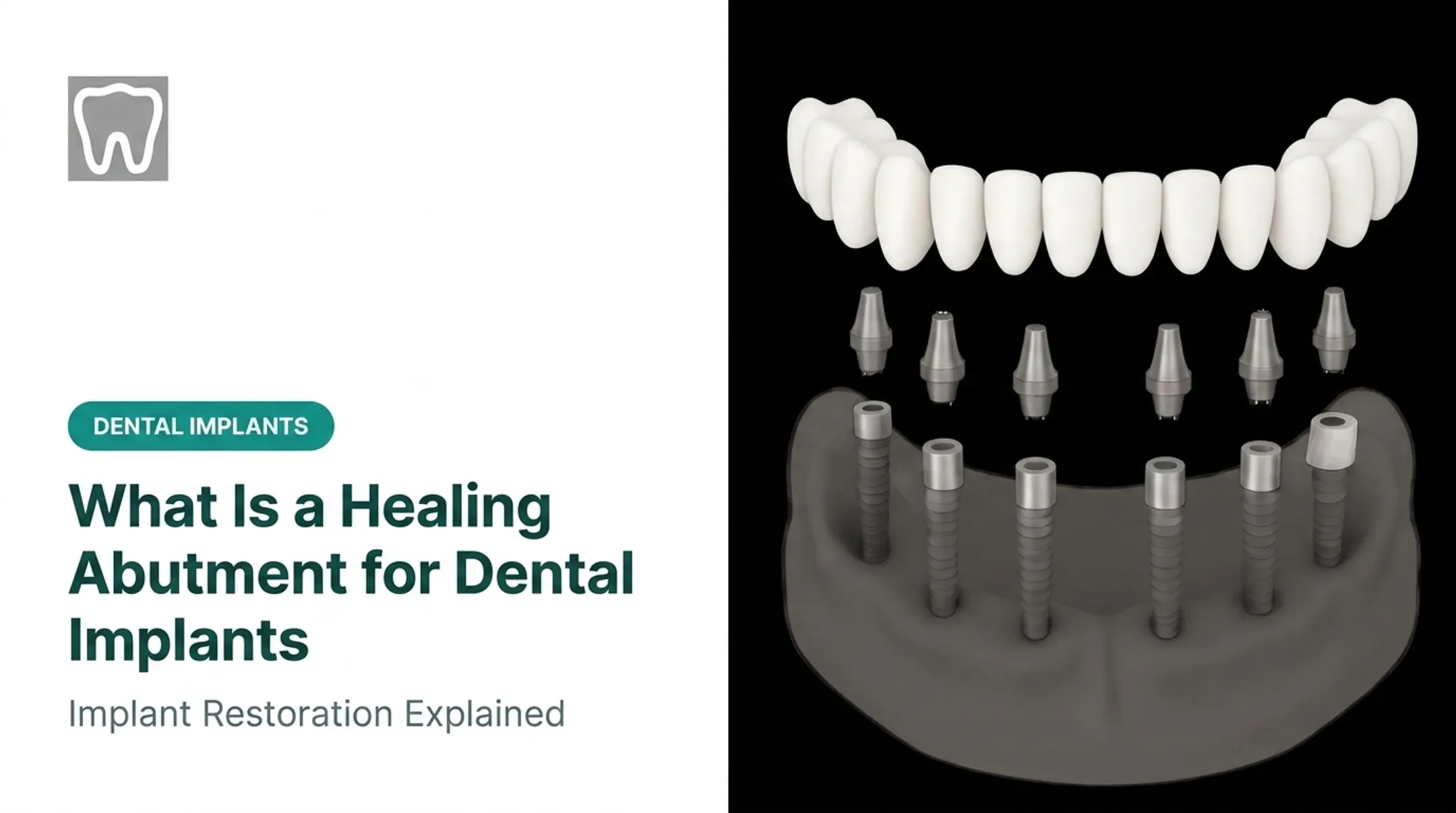 What Is a Healing Abutment for Dental Implants