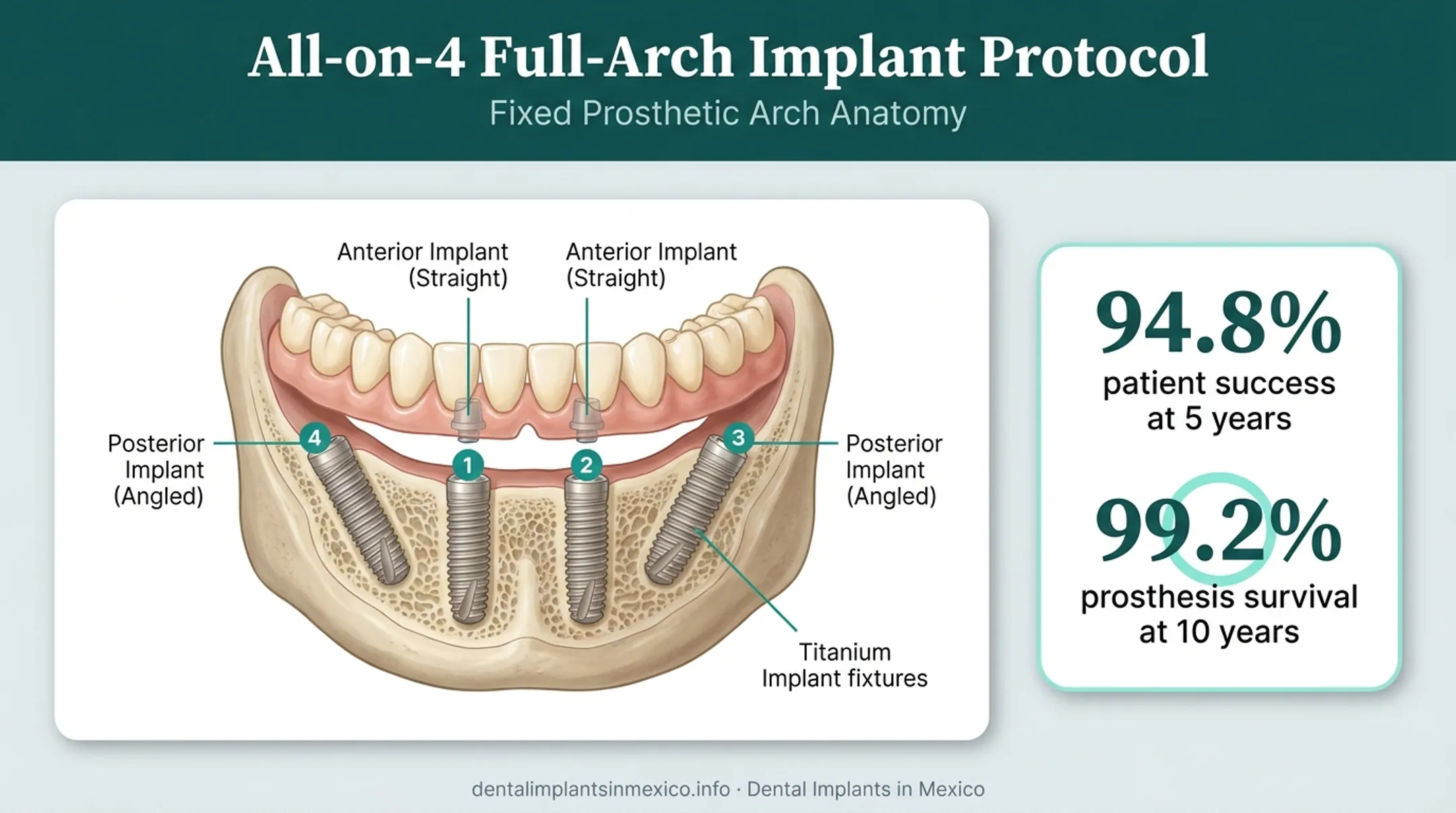 All-on-4 dental implant structure with four angled implants diagram
