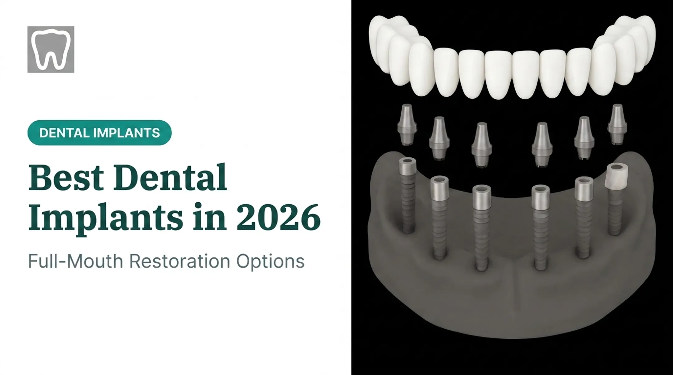 Best Dental Implants in 2026