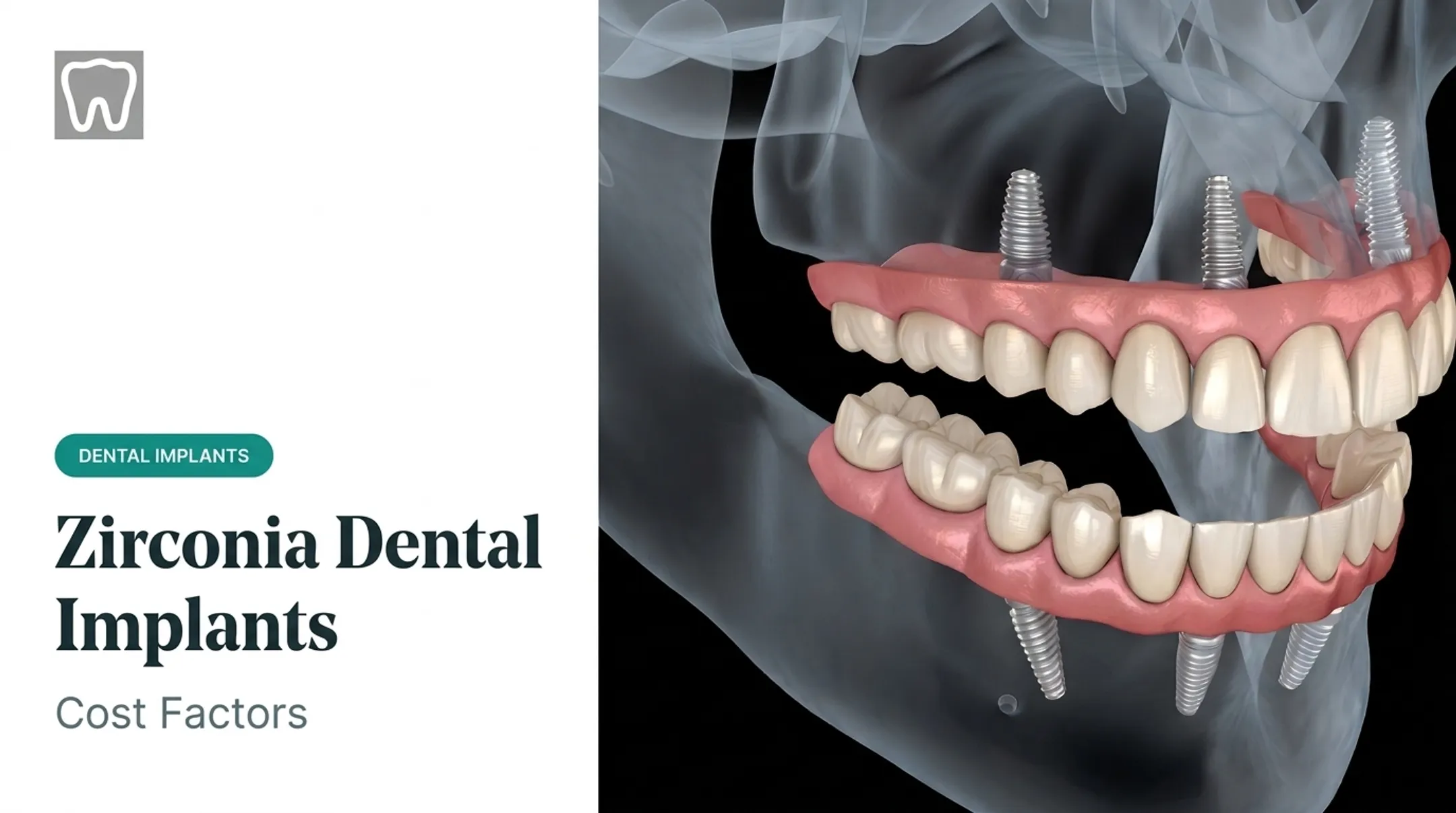 Zirconia Dental Implants: Cost Factors