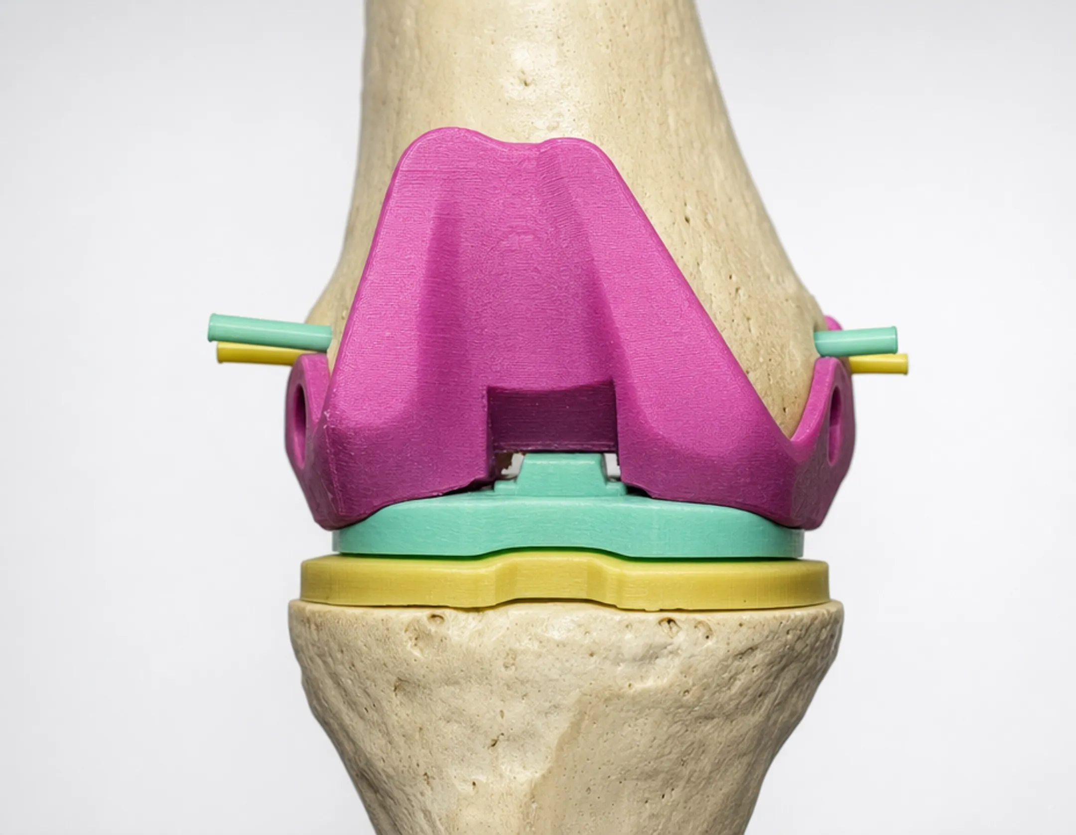3D-printed patient-specific surgical guide for knee osteotomy procedure