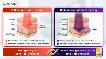 Red light therapy stretch marks home protocol: coverage positioning, session duration, and treatment frequency