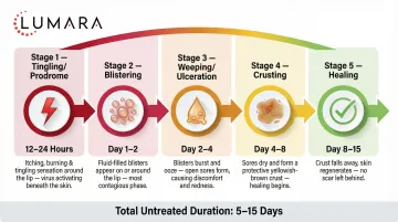 Cold sore red light therapy protocol: prodrome timing, daily outbreak sessions, and maintenance frequency for recurrence reduction