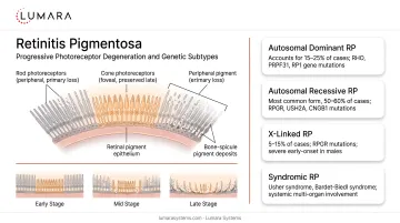 Retinitis pigmentosa mechanism: progressive photoreceptor degeneration pattern and genetic disorder subtypes