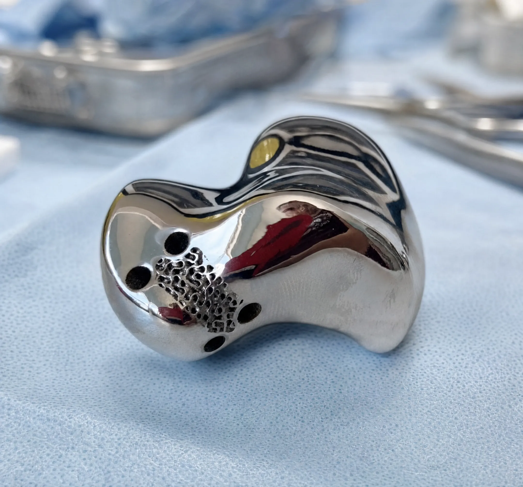 Patient-specific cobalt-chrome orthopedic implant with porous lattice geometry