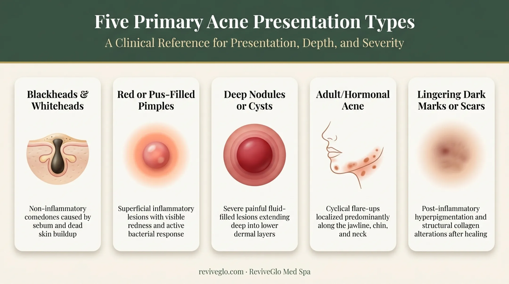 5 common acne types from blackheads to hormonal breakouts