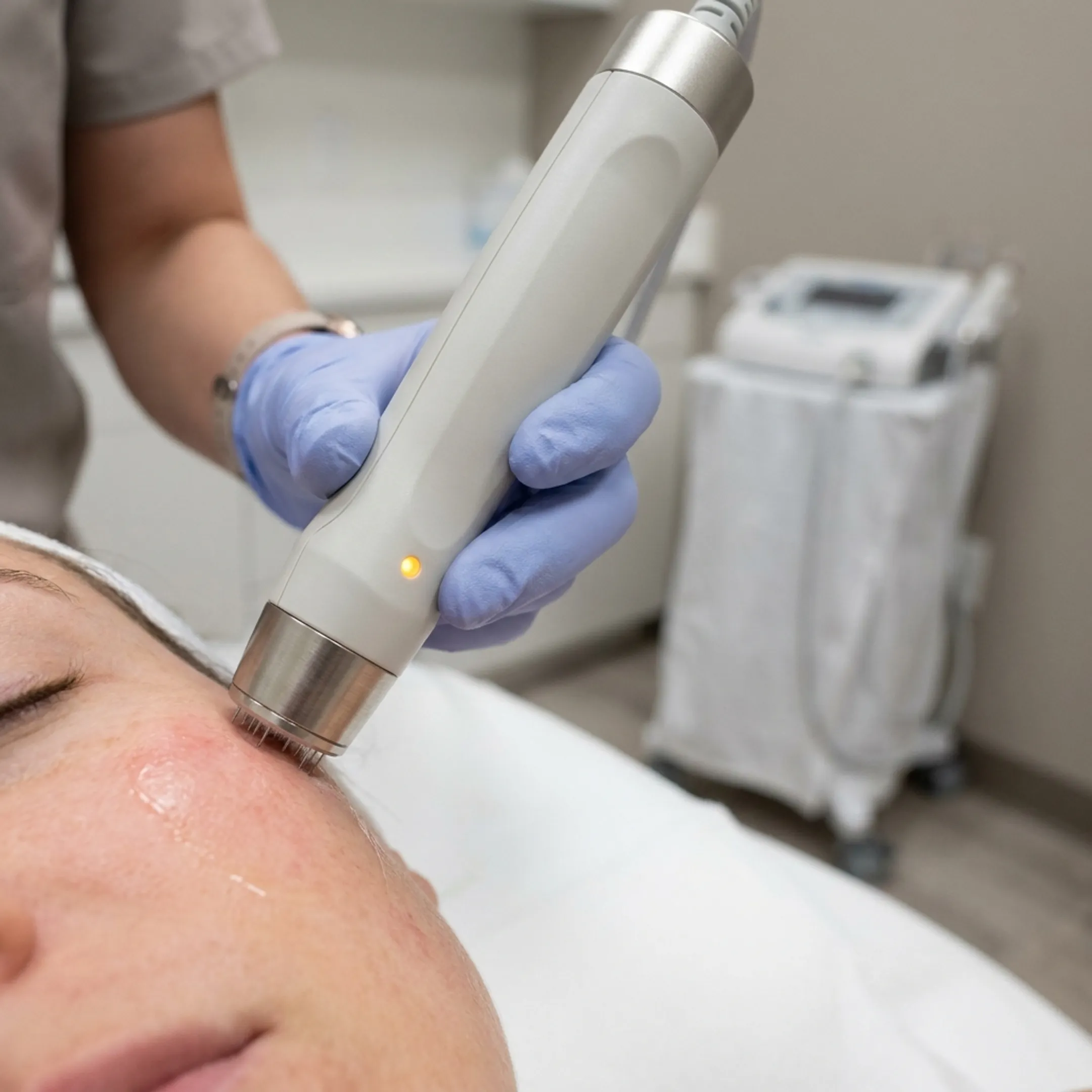 Close-up of radiofrequency microneedling handpiece gently gliding over skin