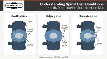 Spinal disc anatomy cross-section showing bulging versus herniated disc comparison