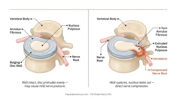Spinal disc anatomy cross-section showing bulging versus herniated disc comparison