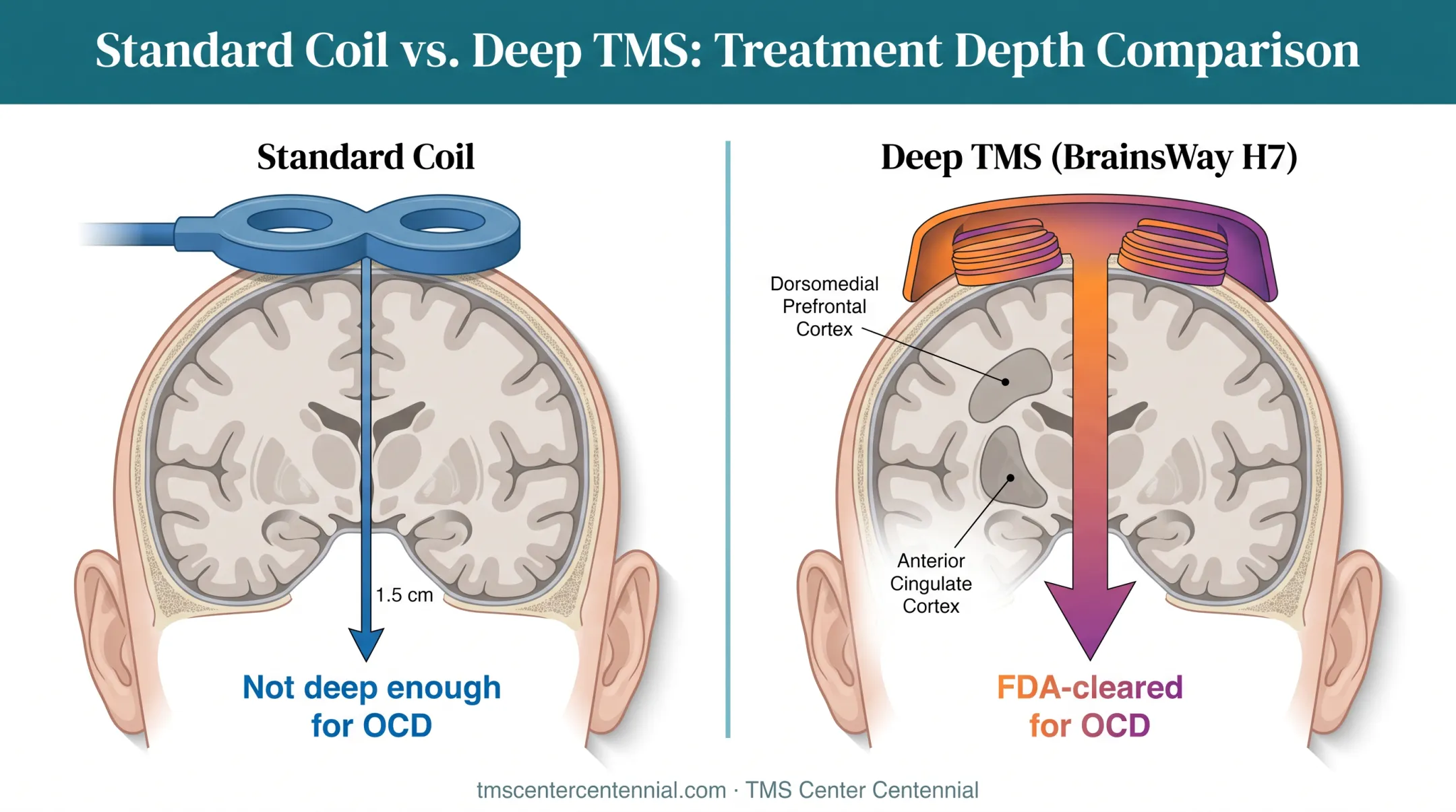 Standard TMS versus Deep TMS coil depth comparison for OCD