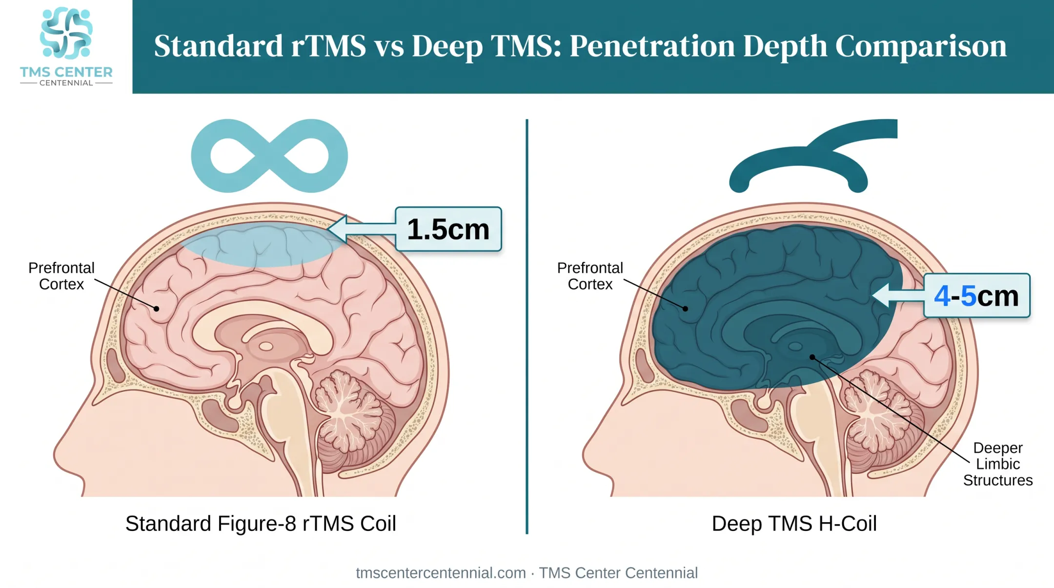 Deep TMS H-coil versus standard rTMS coil depth comparison diagram