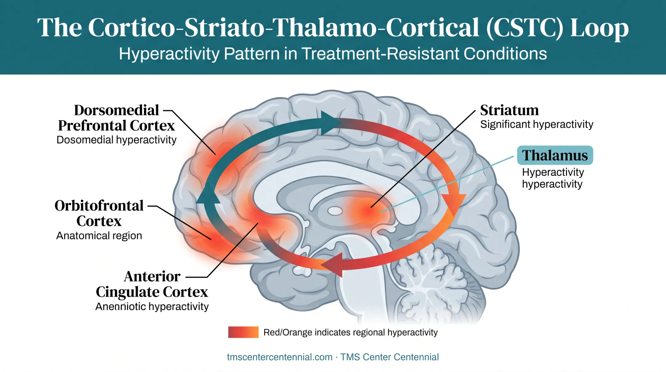 CSTC brain loop circuit diagram showing OCD hyperactive pathway