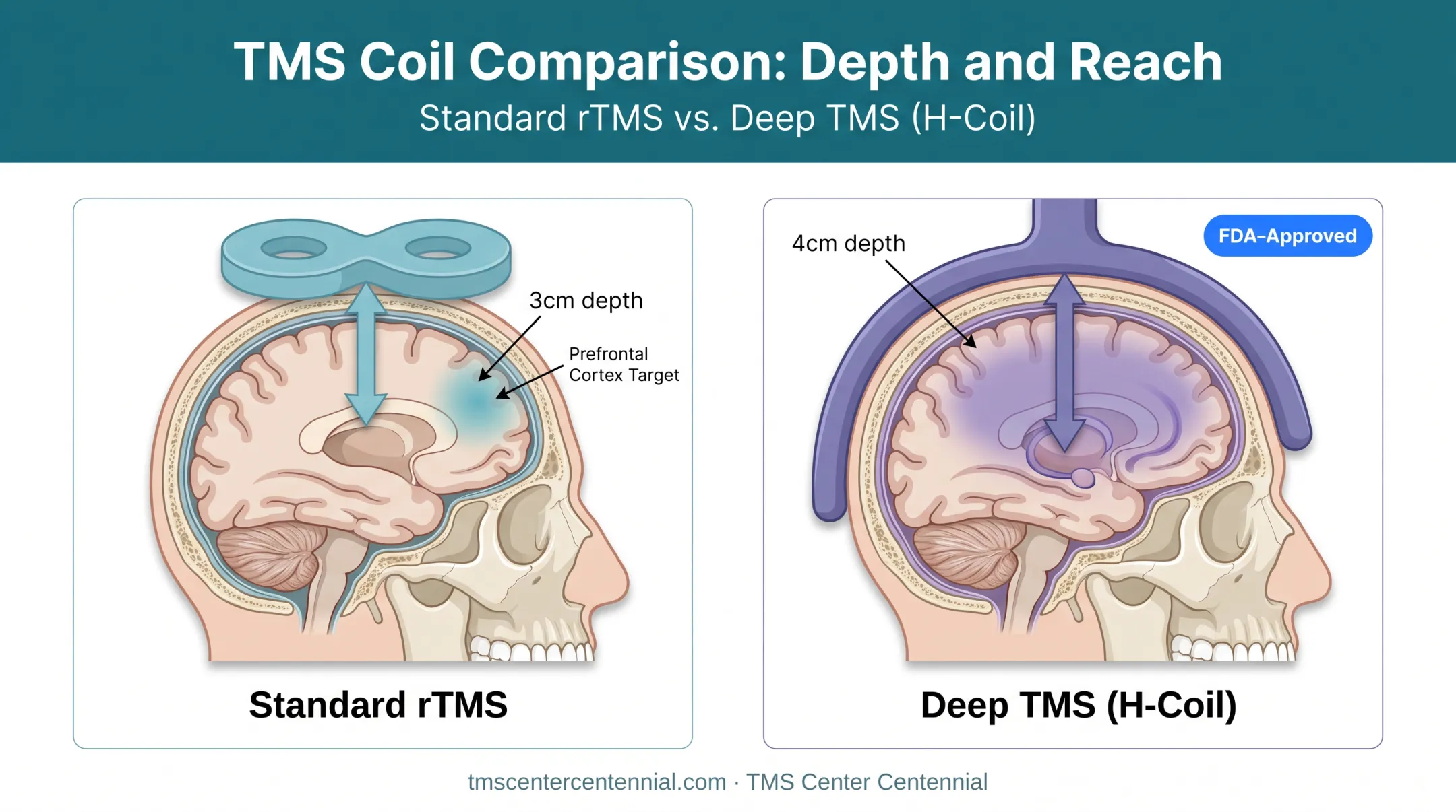 Standard rTMS versus Deep TMS coil depth and coverage comparison