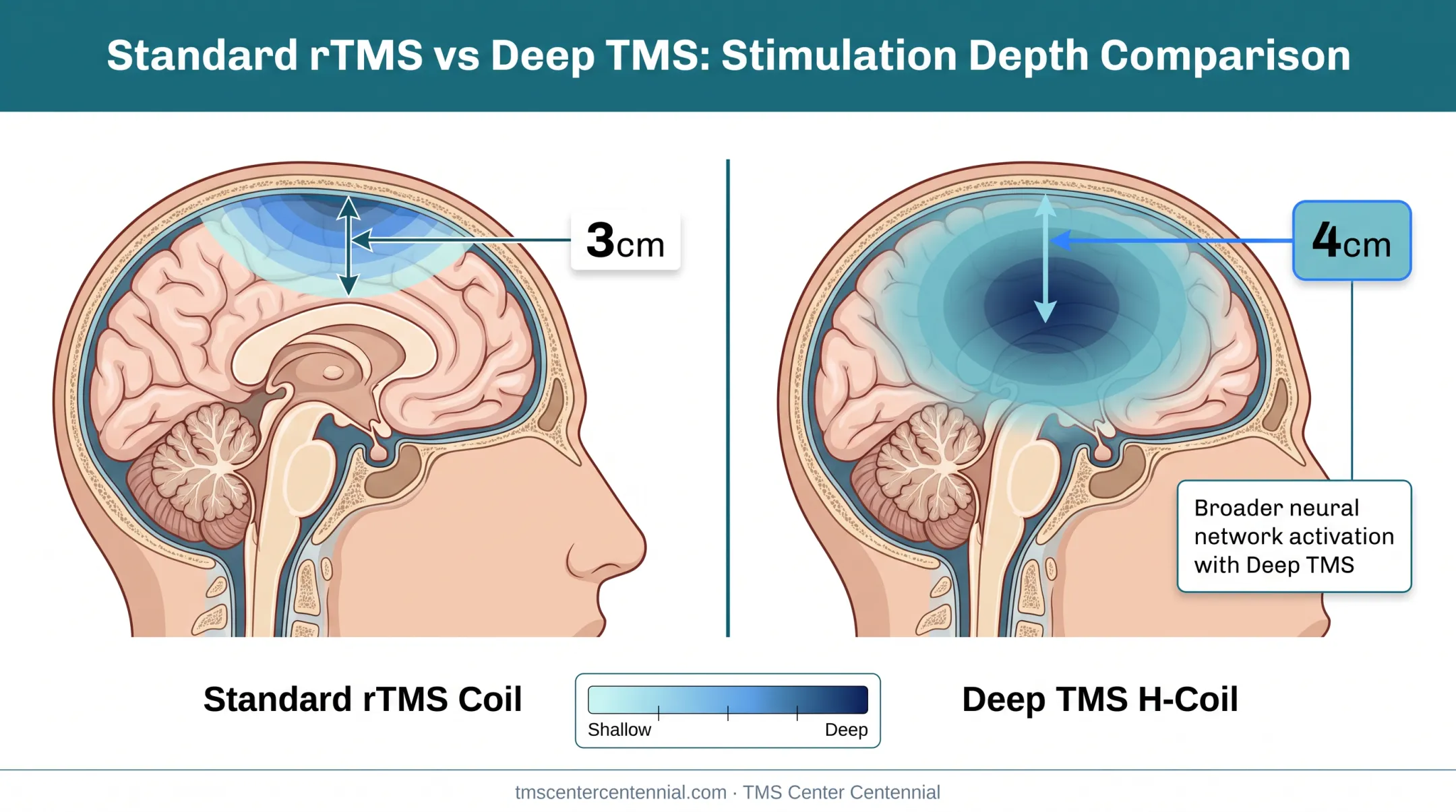 Deep TMS H-Coil versus standard rTMS coil depth comparison