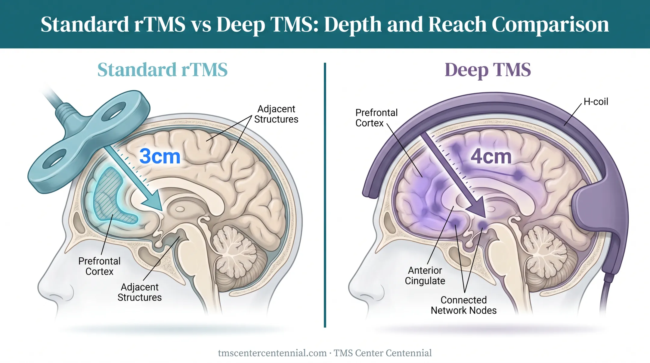 Standard rTMS versus Deep TMS coil depth and coverage comparison