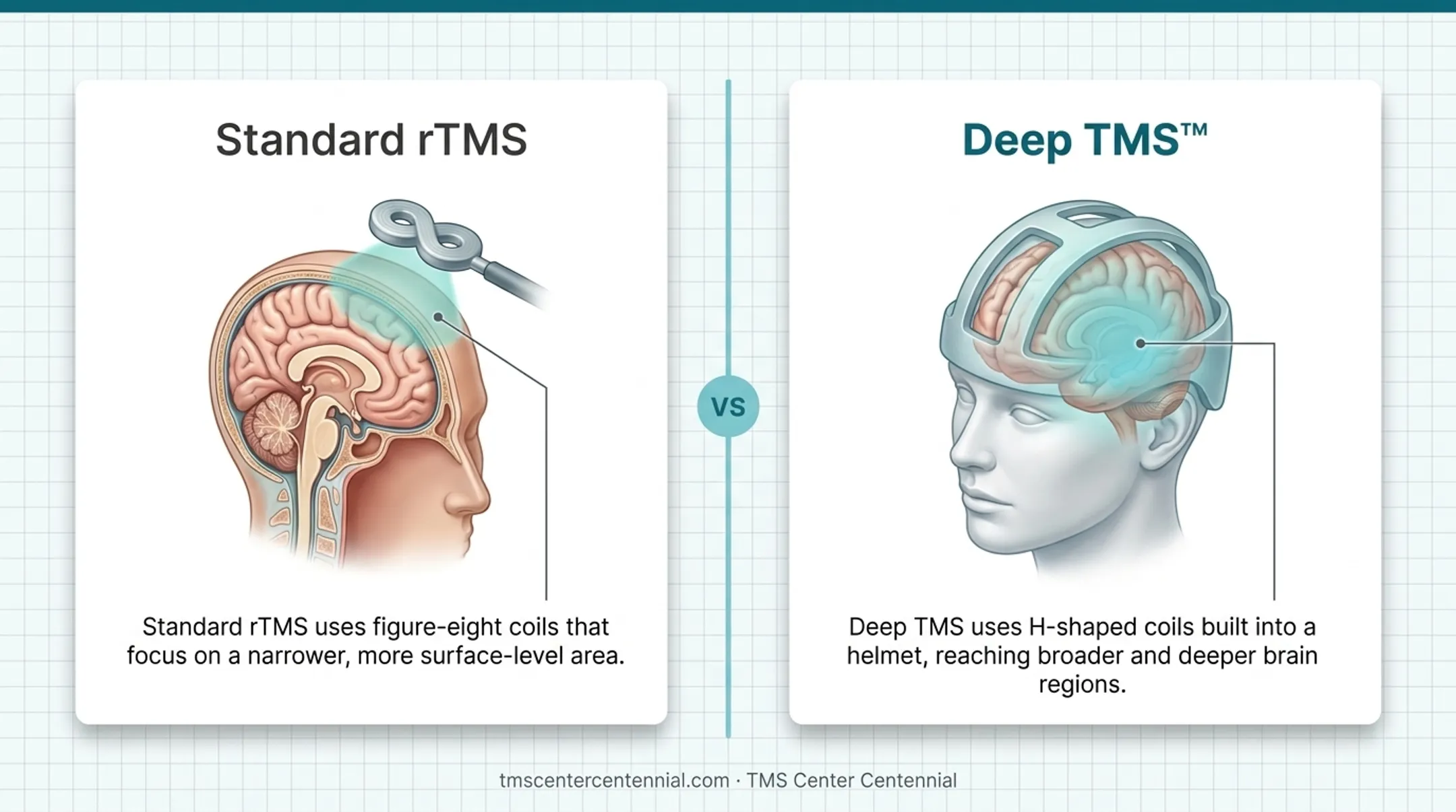 Standard rTMS versus Deep TMS coil design and brain reach comparison