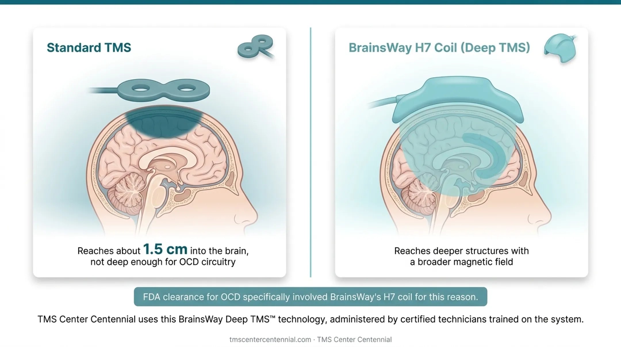 Standard TMS versus Deep TMS coil depth comparison for OCD