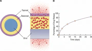 Drug-eluting coronary stent cross-section showing polymer coating and drug release mechanism